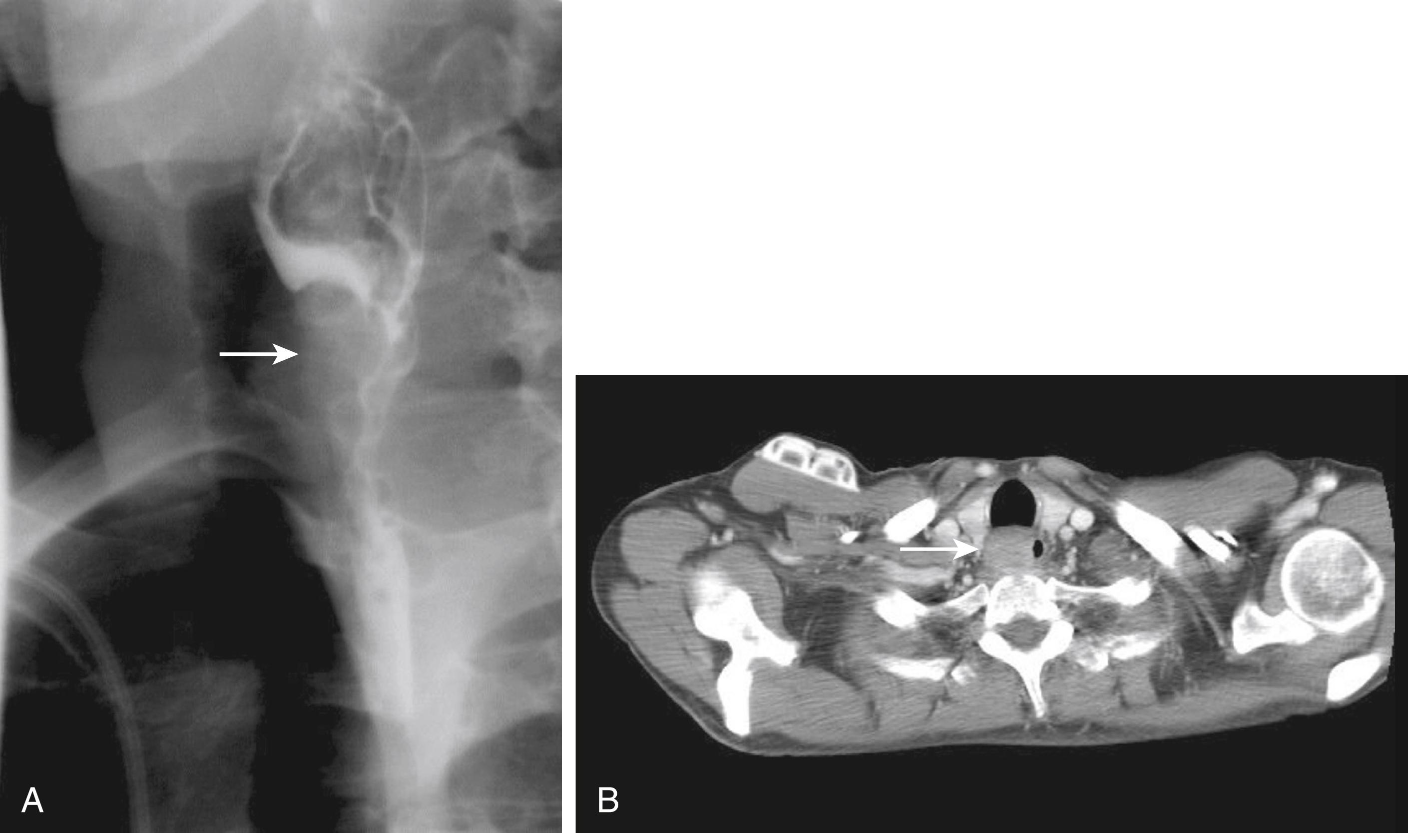 Fig. 50.1, A, Barium esophagogram demonstrating carcinoma of the cervical esophagus (arrow) . B, Computed tomography scan of same patient demonstrating the cancer with narrowing of the lumen of the cervical esophagus (arrow) .