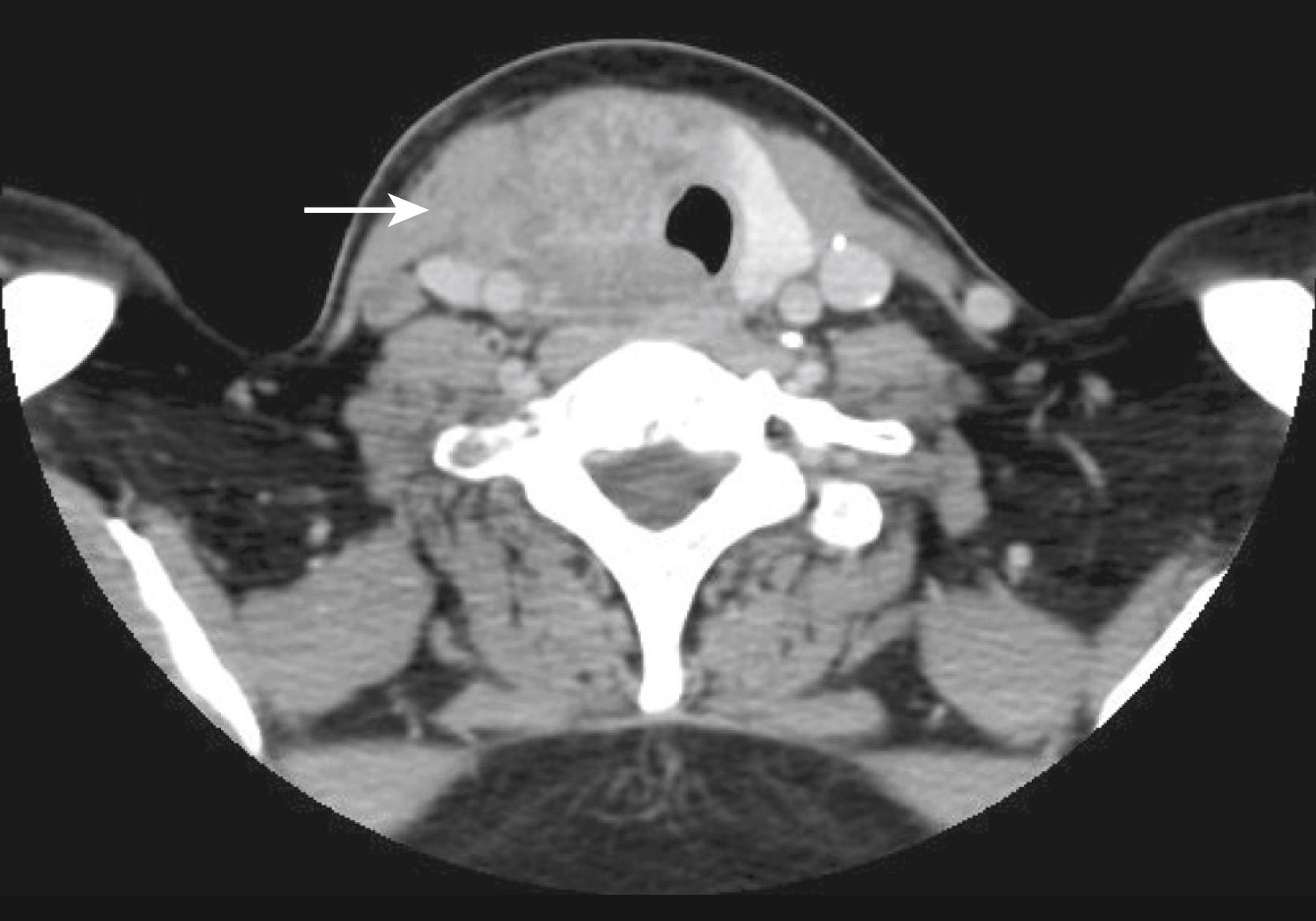 Fig. 50.2, Squamous cell carcinoma of the cervical esophagus with extensive invasion of surrounding structures in the neck (arrow) .