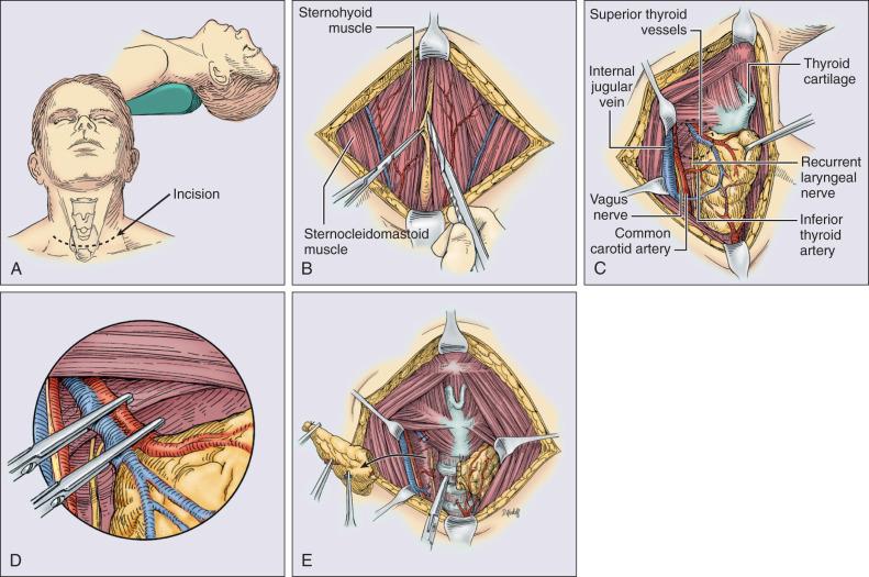 Figure 68.2, Thyroidectomy. (A) The patient is placed with the neck in extension. The thyroid is approached through a Kocher collar incision, which is commonly made approximately 2 cm superior to the sterna notch. (B) The strap muscles are divided in the midline to expose the thyroid gland. (C) The strap muscles are retracted laterally and the thyroid is retracted medially, exposing the structures of the midneck. The recurrent laryngeal nerve can be seen lying within the tracheoesophageal groove. (D) The superior pole vessels are individually clamped and ligated as they enter the thyroid gland. Inferior thyroid vessels, in addition to the thyroidea ima vessels, are individually suture-ligated. (E) The dissection is completed by dissection of the thyroid gland off the trachea. The isthmus is then transected and can be oversewn with a suture for hemostasis.