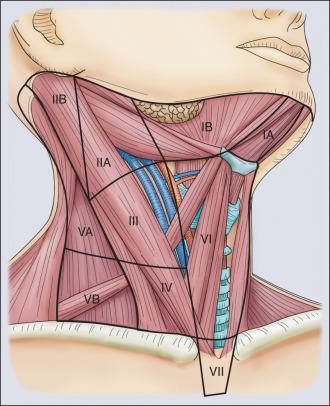 Figure 68.3, The central neck nodes (level VI) are usually the first nodes to receive drainage from the thyroid.