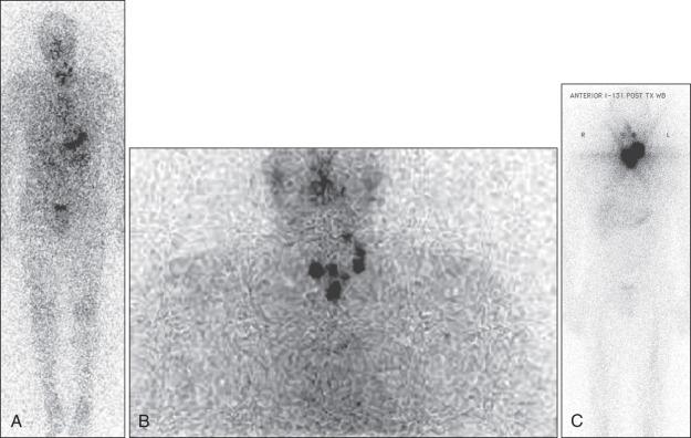 Figure 68.4, (A) Whole-body scan acquired 24 hours after administration of 2 mCi of iodine-123 ( 123 I). (B) Spot view of the neck and chest. There are several areas of uptake indicative of residual thyroid and functioning metastases in cervical lymph nodes. (C) Posttherapy scan made 7 days after administration of 150 mCi of 123 I. There is intense uptake in the region, but the resolution is not as good as with 123 I. There is faint uptake in the liver on the posttreatment scan as a result of metabolism of radioiodinated thyroid hormones at that site.