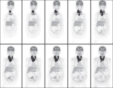 Figure 68.5, Positron emission tomography (PET) scan of a 75-year-old woman with anaplastic cancer of the thyroid. Images were acquired 1 hour after intravenous injection of 15 mCi fluorine-18 fluorodeoxyglucose (FDG). There is intense uptake of FDG in the undifferentiated cancer.