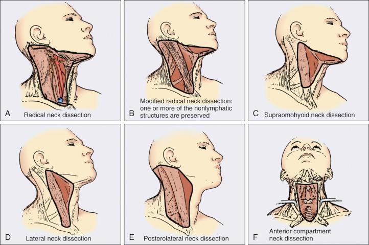 Figure 65.1, Types of neck dissection. (A) Radical. (B) Modified radical: one or more of the nonlymphatic structures are preserved. (C) Supraomohyoid. (D) Lateral. (E) Posterolateral. (F) Anterior compartment.