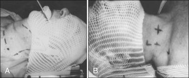 Figure 65.2, Patient in mask in the treatment position. (A) Supraglottic carcinoma. (B) Glottic cancer.