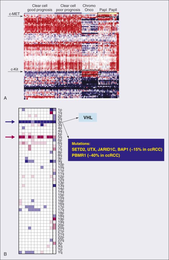 Figure 79.1, Genetic signatures in renal cell carcinoma (RCC). Determining the genetic signature in renal tumors not only has advanced the tumor classification but also will contribute to the optimal selection of therapies. (A) Kinase expression in RCC. These data show the gene expression of approximately 80 kinases (of 518) that have differential expression across the subtypes, with red indicating strong expression. Recognition of c-MET and c-Kit expression allows clustering the samples in specific subtypes. These types of data will guide the selection of patients undergoing treatment with kinase inhibitors. Chromo, Chromophobe; Onco, oncocytoma; PapI, papillary type I; PapII, papillary type II. (B) Summary of the common 3p deletion/5q amplification signature that characterizes clear cell carcinoma. Interesting to note, the 3p region that harbors the VHL gene also contains histone-modifying genes that have been reported to be commonly mutated in this histotype.