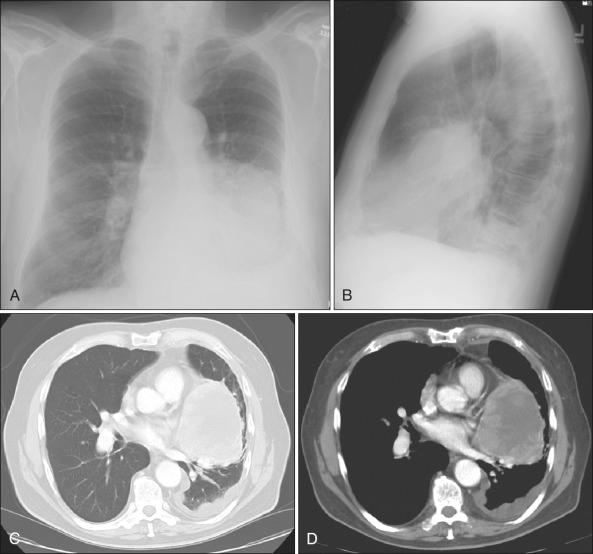 Figure 69.11, Imaging findings in non–small cell lung cancer. (A) Posteroanterior and (B) lateral chest radiographs of patients with locally advanced disease. (C) Computed tomography scans using lung and (D) mediastinal windows.