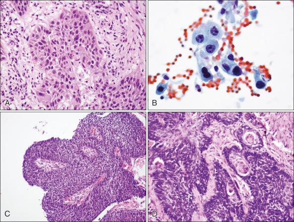 Figure 69.3, Squamous cell carcinoma. (A) Nests of invasive squamous cell carcinoma are seen within fibrous stroma. The tumor cells show abundant eosinophilic cytoplasm. (B) Cytologically (Papanicolaou stain), there are malignant squamous cells in clusters with irregular nuclear shape and nuclear chromatin, and abundant “hard” (keratinized) cytoplasm. (C) Squamous cell carcinoma is commonly associated with central airways, and images can show papillary architecture. (D) The basaloid variant of squamous cell carcinoma is composed of tumor cell nests with peripheral nuclear palisading and keratinization toward the center of the nests.