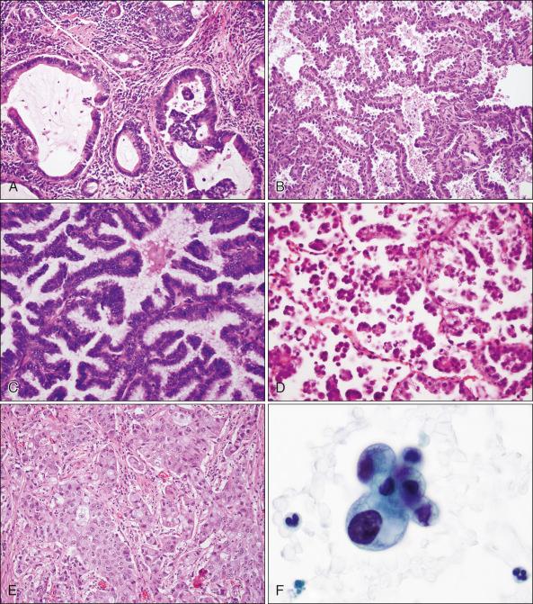 Figure 69.4, Growth patterns of adenocarcinoma. (A) Image of the acinar (glandular) pattern shows malignant glandular structures invading a fibrous stroma. (B) The lepidic pattern can be pure, as in adenocarcinoma in situ (AIS), or mixed with other patterns of adenocarcinoma. It consists of malignant epithelial cells lining alveolar walls without invasion. (C) Image of papillary adenocarcinoma shows tumor cells lining papillary structures with fibrovascular cores and loss of the underlying alveolar architecture. (D) Image of micropapillary pattern shows tumor cells forming small simple papillary structures without fibrovascular cores. (E) Image of solid pattern shows sheets or nests of polygonal cells that may contain mucin-containing cytoplasmic vacuoles. (F) Image of adenocarcinoma by cytology (Papanicolaou stain) shows three-dimensional clusters of malignant cells with vacuolated cytoplasm.