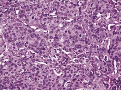Figure 69.5, Large cell carcinoma consists of sheets of undifferentiated cells without glandular or squamous differentiation. Prominent nucleoli are shown.