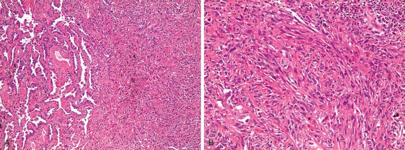 Figure 69.6, Pleomorphic carcinoma. (A) In this example, the tumor is composed of adenocarcinoma and spindle cell carcinoma components. (B) Image of the spindle cell carcinoma component shows cytologically malignant tumor cells arranged in fascicles.