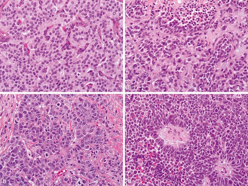 Figure 69.7, Neuroendocrine tumors of the lung. (A) A typical carcinoid tumor has an organoid (nested) and trabecular pattern of growth. (B) An atypical carcinoid tumor has tumor nests with peripheral nuclear palisading and focal tumor necrosis. (C) Image of a large cell neuroendocrine carcinoma displays tumor nests with peripheral nuclear palisading and nuclear rosettes. Tumor cell nucleoli and frequent mitoses are readily identified. (D) Image of a small cell carcinoma shows hyperchromatic nuclei with inconspicuous nucleoli, scant cytoplasm, and frequent mitoses.