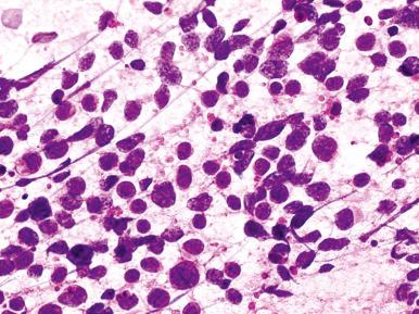 Figure 69.8, Small cell carcinoma. At cytologic evaluation (hematoxylin-eosin stain), the nuclear features (“salt-and-pepper” chromatin pattern), scant cytoplasm, and crushing of cells are evident.