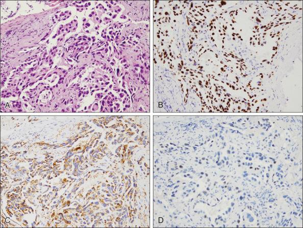 Figure 69.9, Immunohistochemistry (IHC) for subtyping non–small cell carcinoma. (A) Poorly differentiated carcinoma, hematoxylin-eosin stain. (B) IHC for thyroid transcription factor 1 (TTF-1) stains the nuclei of tumor cells. (C) IHC for napsin A stains the cytoplasm of tumor cells. (D) IHC for p63 shows only focal weak staining of nuclei of tumor cells. This staining pattern is consistent with adenocarcinoma (TTF-1+, napsin A+, p63− [or weak]).