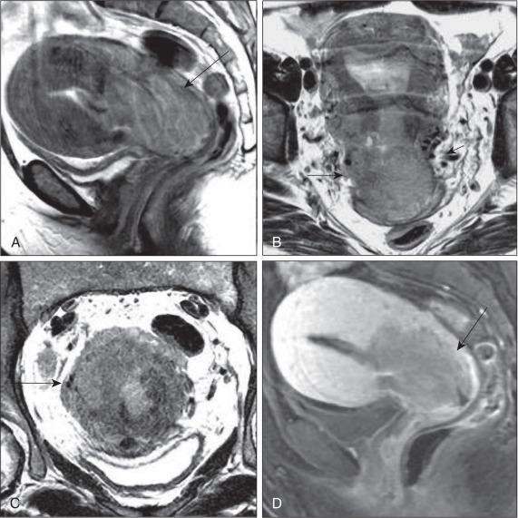 Figure 84.11, Cervical cancer on magnetic resonance images. (A) Sagittal T2-weighted image showing a heterogeneous isointense mass in the cervix extending into the posterior wall of the uterine body (arrow). (B) T2-weighted image sliced coronally through the cervix showing a mass protruding into the uterine cavity (arrow). (C) T2-weighted image sliced axially across the cervix showing a bulky, eccentric cervical mass on the right side with spread beyond the T2 hypointense ring of the cervical stroma into the parametrium (arrow). (D) T1-weighted gadolinium-enhanced image revealing clear delineation of the mass relative to the adjacent uterus (arrow).