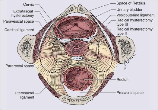 Figure 84.12, Diagram of pelvic anatomy and types of hysterectomy.
