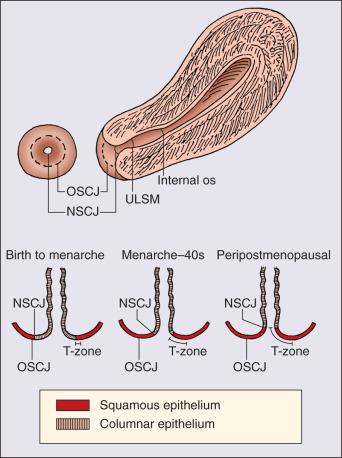 Figure 84.2, The transformation zone and squamocolumnar junction. NSJC, New squamocolumnar junction; OSJC, original squamocolumnar junction; T-zone, region between original and new squamocolumnar junctions; ULSM, uterine isthmus.