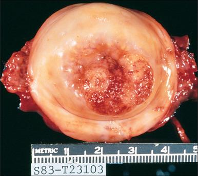 Figure 84.3, Invasive squamous cell carcinoma. A mass is present on the external os.