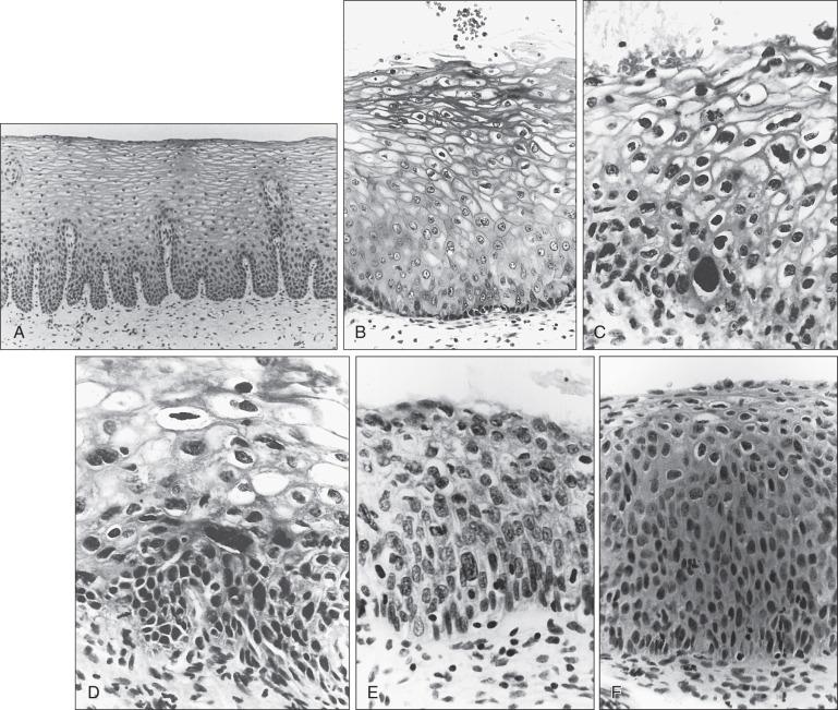 Figure 84.4, (A to F) Histologic portraits of normal stratified squamous epithelium of the cervix and cervical intraepithelial neoplasia.