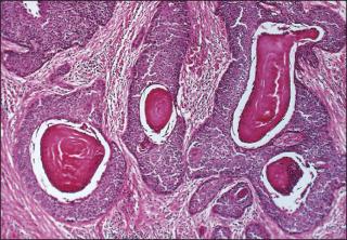 Figure 84.5, Invasive squamous cell carcinoma of the keratinizing type.