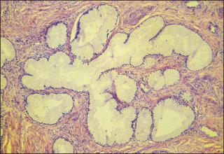 Figure 84.6, Adenoma malignum. A gland with a bizarre shape is lined by benign-appearing tumor cells.