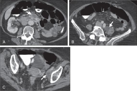 Figure 84.9, Pattern of nodal metastases (arrows) on computed tomography scans. Necrosis is a common feature of squamous cell carcinoma. (A) Paraaortic node. (B) Retroperitoneal node. (C) External iliac node.
