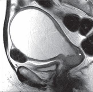 Figure 84.10, Cervical cancer on magnetic resonance image. T2-weighted sagittal image shows a cervical mass (arrow) causing stenosis and fluid accumulation in uterus.