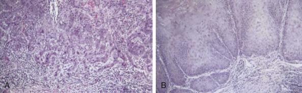 Fig. 69.1, Variant growth patterns of squamous cell cancer of the vulva. (A) Infiltrative pattern of growth with discontinuous satellites of malignant cells, sometimes called a “spray pattern” of growth. (B) Verrucous cancer with a bulbous, pushing front of invasion into the surrounding stroma.