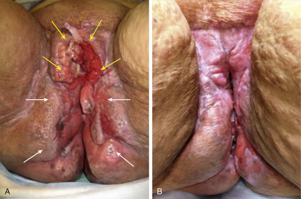 eFig. 69.8, (A) Pretreatment photograph of a young woman with locally extensive T3Nx squamous cancer of the vulva with involvement of the distal urethra and vagina arising in chronic dermatitis of the vulva, anus, and perineum associated with severe inflammatory bowel disease (Crohn colitis). Yellow arrows delineate gross tumor. White arrows indicate areas of markedly abnormal and inflamed skin without clinical involvement of malignancy. Following diverting colotomy, this patient was treated with preoperative chemoradiation delivering 47.6 Gy with 2 cycles of synchronous 5-fluorouracil/cisplatin employing a dose and fractionation schedule modified from GOG 101. Target volumes included the primary and both groins using the modified segmental boost technique. Three weeks following completion of chemoradiation, an examination under anesthesia suggested complete clinical involution. Seven negative deep circumferential biopsies were obtained from the periphery of the original tumor volume and no further treatment was employed. (B) Photograph of this patient 4.5 years after completion of treatment. There has been no evidence of recurrence.