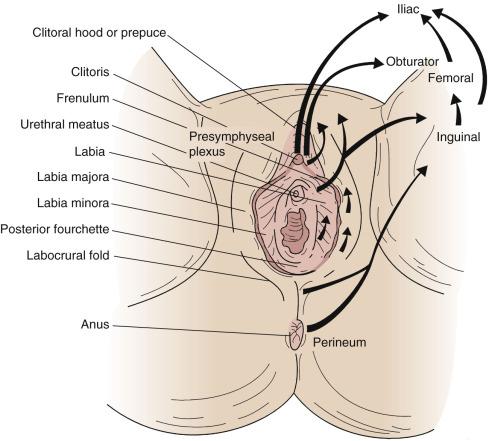 Fig. 69.2, Lymphatic drainage of the vulva and perineum. Arrows indicate the flow patterns.