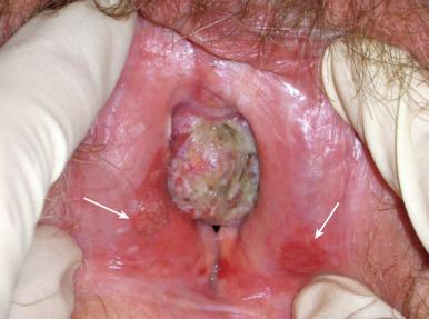 eFig. 69.2, Multifocal squamous cancer of the vulva with dominant mass involving distal urethra and vagina. Bilateral, somewhat symmetrical, noncontiguous foci of invasive disease (white arrows) may represent autotransplantation of malignant cells onto moist mucosal surfaces, so-called contact lesions .