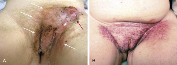 eFig. 69.3, (A) Pretreatment photograph of a 50-year-old patient with a large vulvar cancer with bilateral groin metastases and extensive dermal lymphatic permeation (white arrows) . Bulky left inguinofemoral node metastases encased the femoral artery and vein and eroded through overlying skin (red arrow) . (B) Photograph of patient 2.5 years after completion of high-dose chemoradiation consisting of 3 cycles of 5-fluorouracil/cisplatin with predominantly twice-daily radiation and planned volume reductions. Treatment was initiated urgently with 3-dimensional technique because of intermittent arterial bleeding from a branch of the femoral artery. Subsequent reduced volumes were treated with intensity-modulated radiotherapy (IMRT). Cumulative dose to gross disease was 65 Gy. Extensive bolus was employed to ensure full dose to areas of dermal lymphatic permeation based on both clinical assessment and imaging findings (positron emission tomography/computed tomography and magnetic resonance imaging). The patient remains clinically cancer free with late sequelae attributed to radiation, including severe skin changes (atrophy, telangiectasis, fibrosis) and left leg edema with multiple episodes of cellulitis mandating chronic prophylactic antibiotic administration.