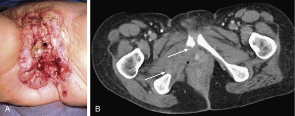 eFig. 69.4, (A) Neglected, locally extensive vulvar cancer in a 47-year-old woman with a remote history of vulvar surgery for extensive condylomata. Despite extensive destruction of soft tissues, the patient remained continent of urine and feces. Progressive pain from bone destruction ultimately brought the patient to medical attention. (B) Destruction of the inferior ischial ramus (white arrows) by direct extension of locally advanced squamous cancer of the vulva.