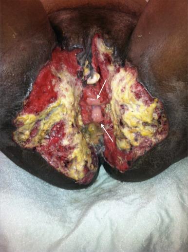 eFig. 69.5, Locally extensive squamous cancer of the vulva in an African immigrant with inadequately treated HIV. Progressive destruction of the entire vulva and adjacent organs (urethra, anus) resulted in the functional equivalent of a cloaca. Visible at the center of the photograph is grossly normal distal vaginal epithelium covering anterior and posterior walls (white arrows).