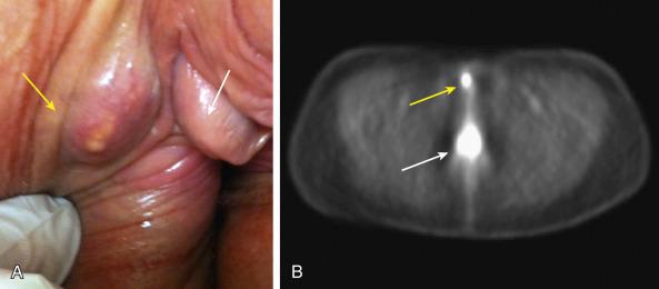 eFig. 69.6, (A) Mass in the right labia (yellow arrow) in a phenotypically female patient with XXY karyotype (Klinefelter syndrome) with X-linked androgen insensitivity and ambiguous genitalia. Note the clitoral hypertrophy (white arrow) . The primary squamous cancer was in the right Bartholin complex. The labial mass was initially thought to be a sebaceous cyst. However, sebaceous cysts are usually at the hairline along the crests of the labia majora, and the presence of subtle neovascularity over this mass was concerning. (B) When positron emission tomography/computed tomography revealed both groin node metastases and intense radiotracer uptake in the labial mass, a biopsy confirmed an in-transit labial metastasis. Intense fluorodeoxyglucose uptake at the primary site (white arrow) involving the posterior fourchette and perineal body and at the in-transit metastasis in the right labia (yellow arrow) .