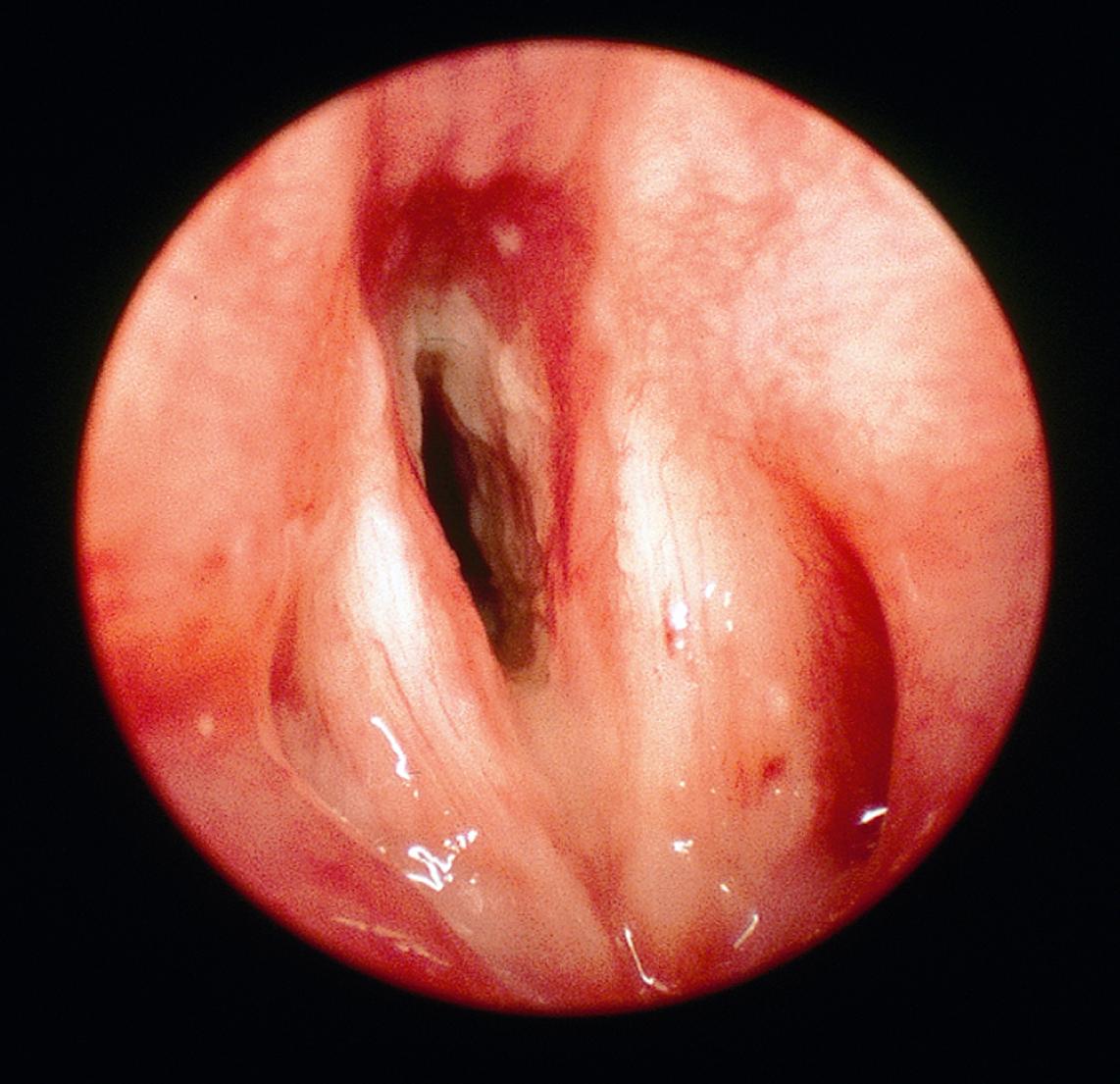 FIGURE 243.1, Endoscopic view of Candida albicans laryngitis in a 12-year-old girl with systemic lupus erythematous who was receiving high-dose glucocorticoid therapy and antibiotics. She did not have oral candidiasis.