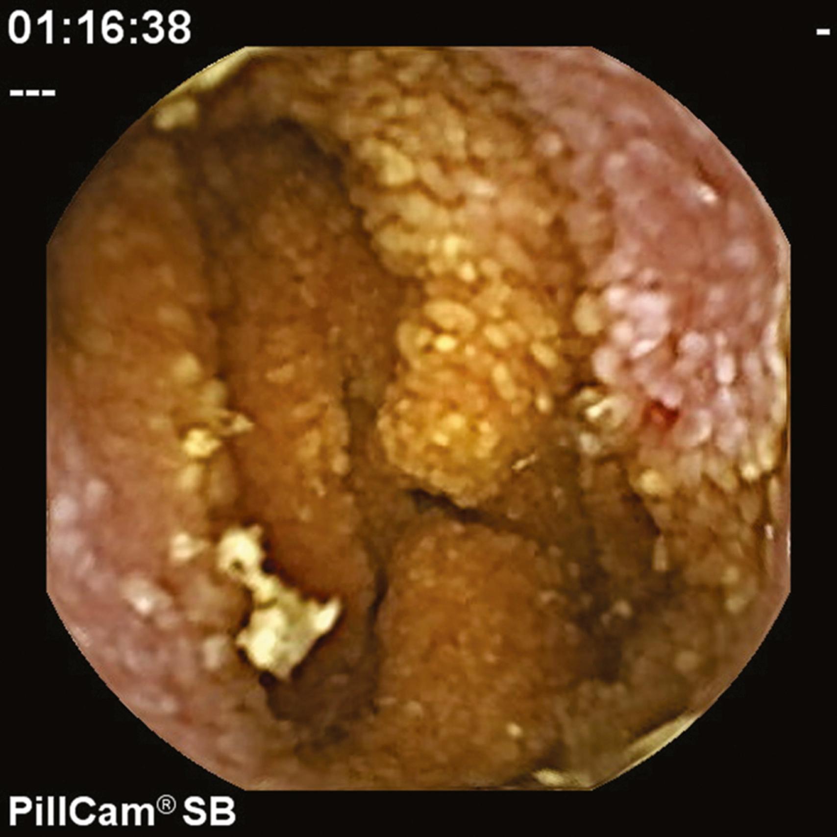 Fig. 63.2, Dilated lacteals and focal bleeding in the mid small bowel seen on capsule endoscopy of an 8-year-old girl with protein-losing enteropathy and edema.