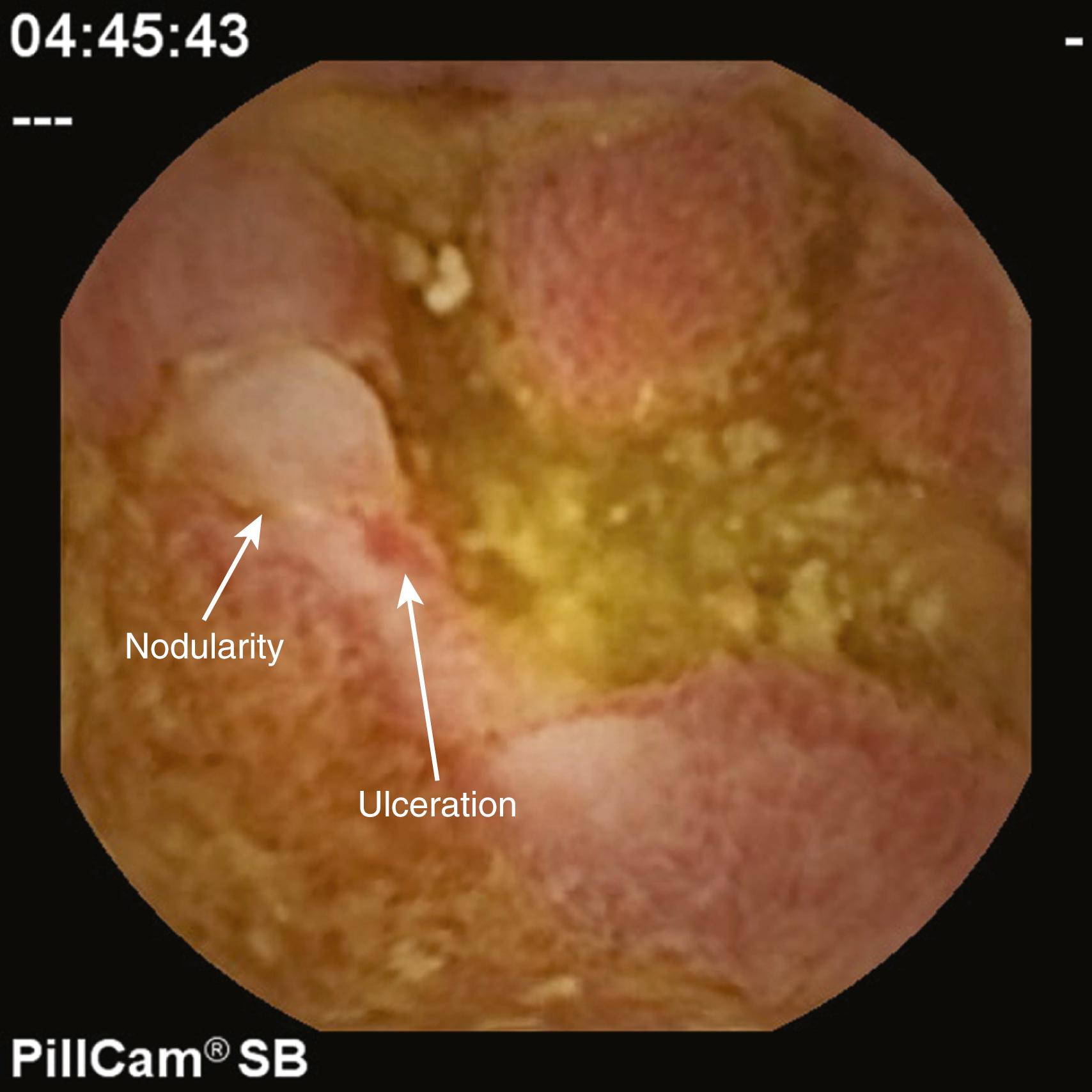 Fig. 63.3, Capsule endoscopy image showing jejunal ulceration, exudates, and nodularity in a child with Crohn disease.