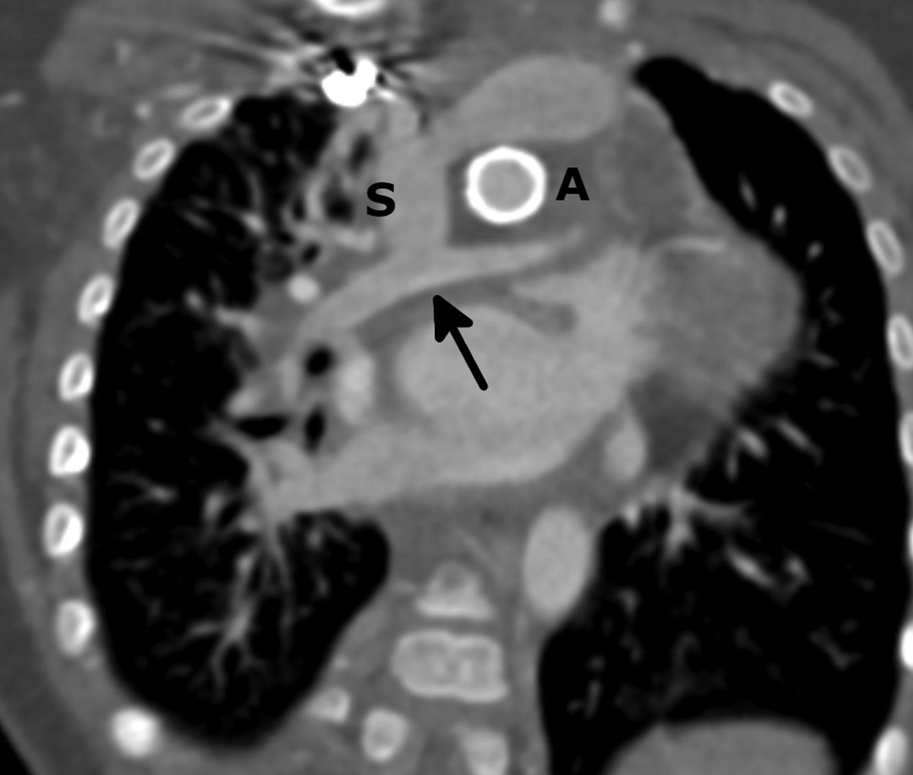 Figure 4-1, Oblique coronal reformatted image from a CT angiogram performed to evaluate patency of a Glenn shunt. The image shows a widely patent Glenn shunt (direct connection between the superior vena cava ( S ) and the pulmonary arteries [ arrow ]). An aortic stent ( A ) is also present.