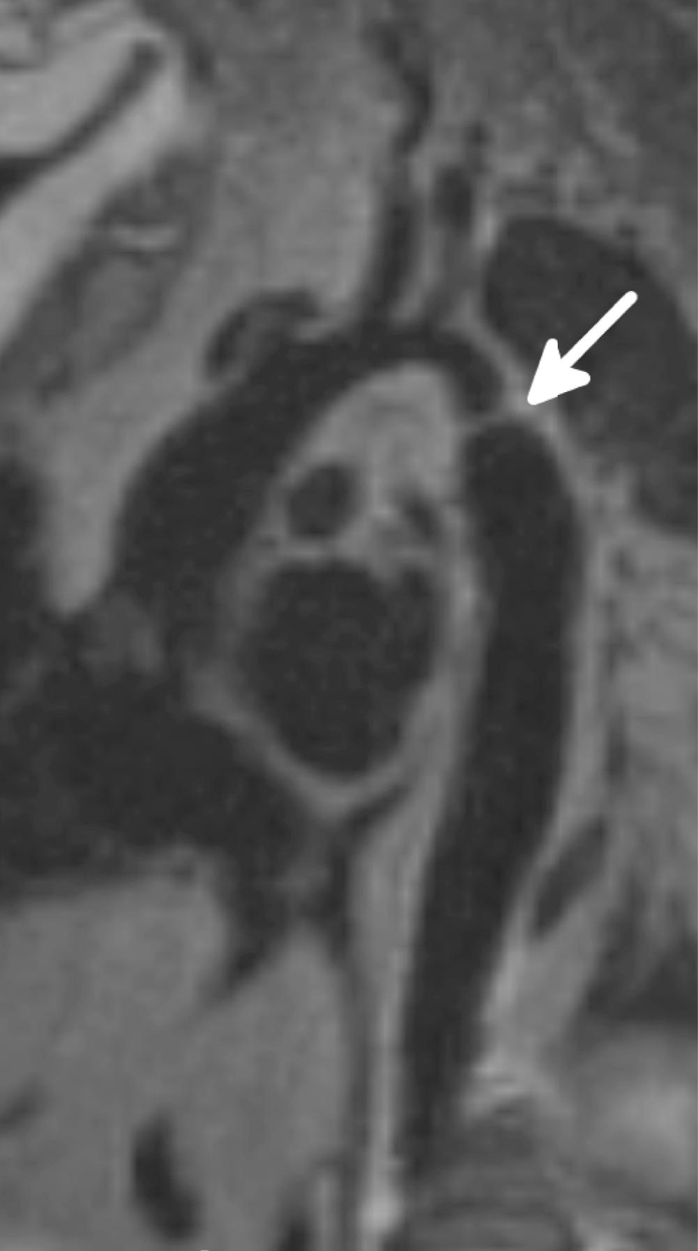 Figure 4-2, Double inversion recovery, T1-weighted, black-blood, oblique sagittal (“candy cane”) image shows a focal narrowing of the aortic isthmus ( arrow ) consistent with coarctation.