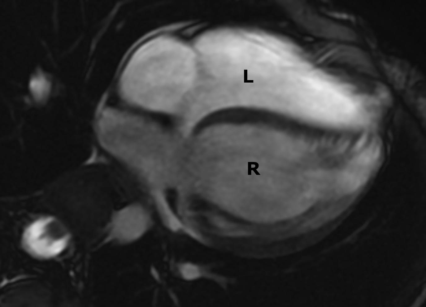 Figure 4-3, Balanced steady-state free precession (bSSFP) bright-blood four-chamber image in a child with congenitally corrected (L-) transposition of the great arteries (L-TGA) shows the morphologic left ventricle ( L ) anterior and to the right of the morphologic right ventricle ( R ). Such images through the heart can be obtained in cine mode and are used to evaluate cardiac motion and functional parameters, such as ventricular ejection fraction.