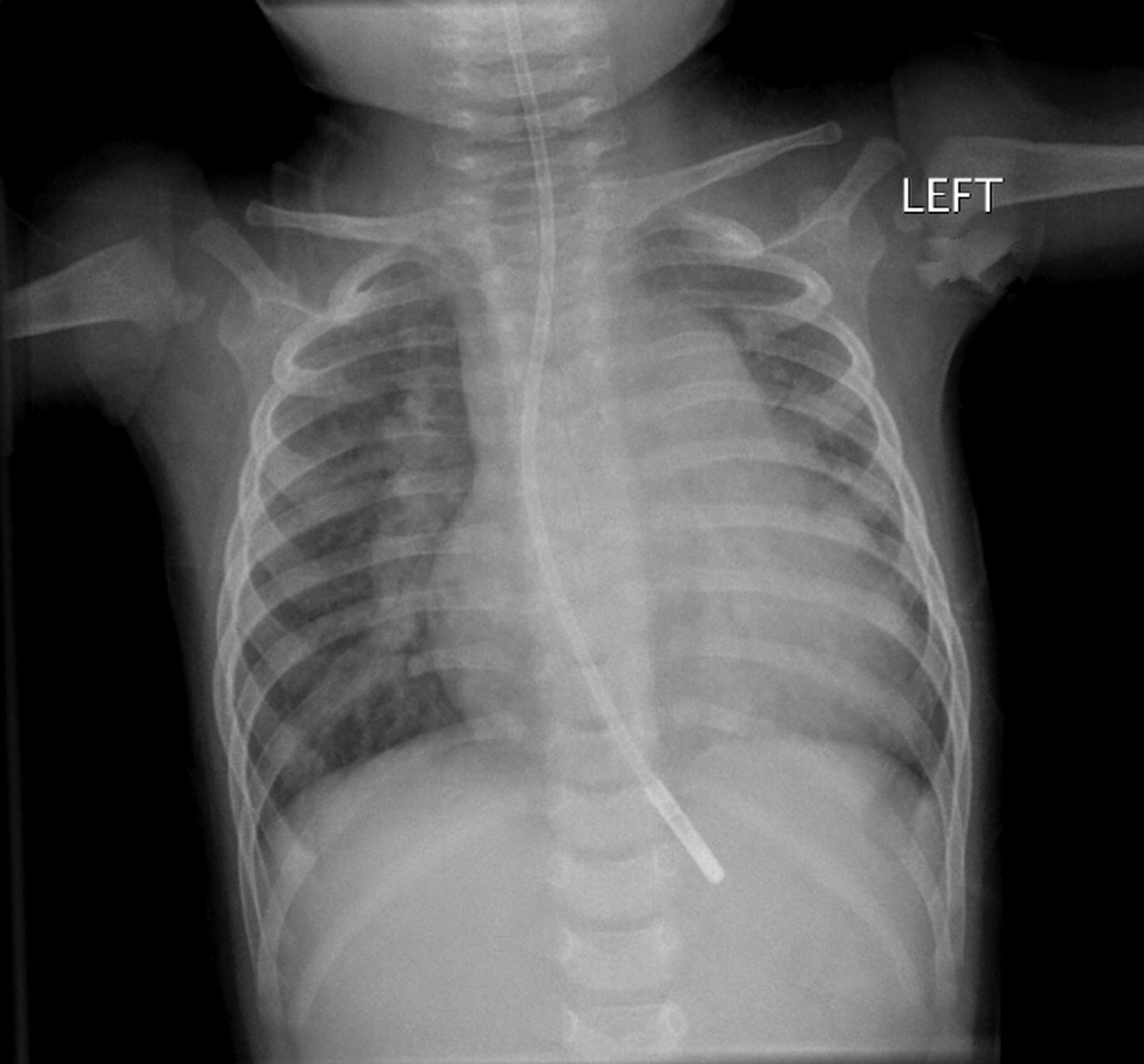 Figure 4-4, Frontal chest radiograph in a child with a perimembranous ventricular septal defect shows shunt vascularity with increased number and size of visible pulmonary arteries. Cardiomegaly is present as well.