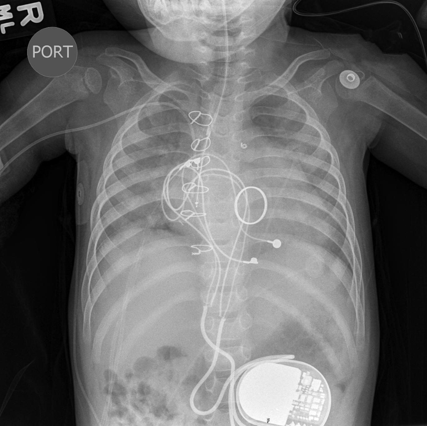 Figure 4-5, Increased pulmonary venous flow/pulmonary edema in a neonate posttricuspid valve repair and mitral valve replacement. Note the prominent but indistinct pulmonary vascularity.