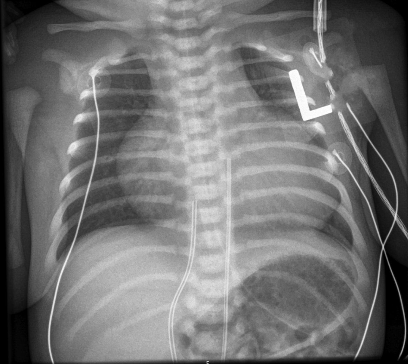 Figure 4-6, Critical pulmonic stenosis on frontal chest radiograph.