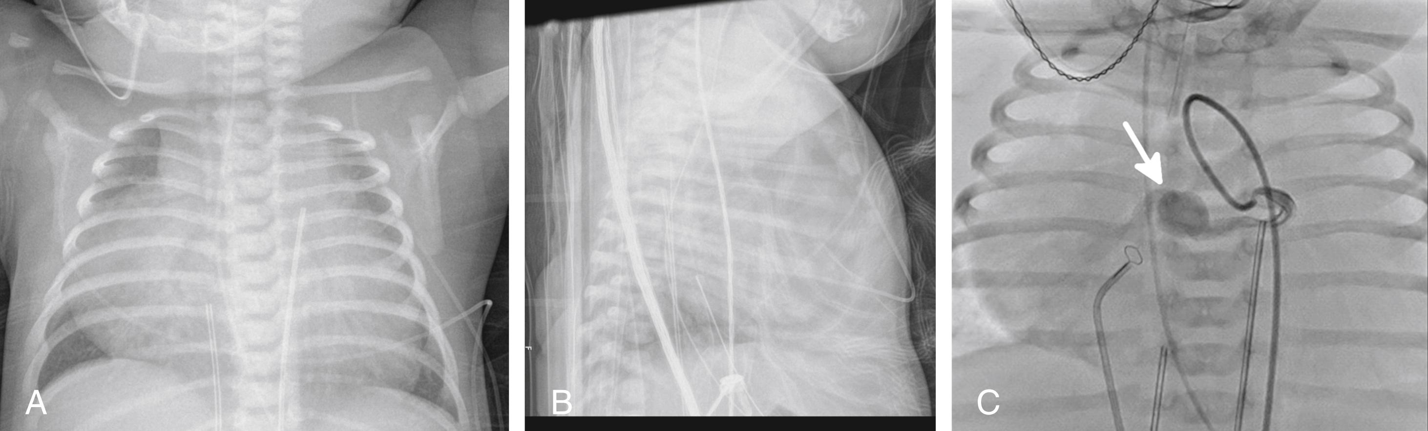 Figure 4-8, Coronary-atrial fistula causing severe cardiomegaly.