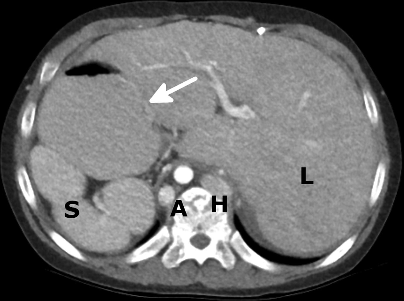 Figure 4-10, Polysplenia.