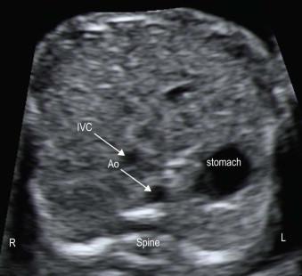 FIGURE 14-1, A cross-section of the upper abdomen demonstrates the stomach lying on the left of the fetus in the usual position relative to the abdominal aorta and inferior vena cava. The abdominal aorta lies anterior and to the left of the spine, with the inferior vena cava anterior and to the right of the aorta.