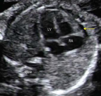 FIGURE 14-11, The fetal heart is seen in an apical four-chamber view. The appearance of a black rim (arrow) represents normal pericardial fluid.