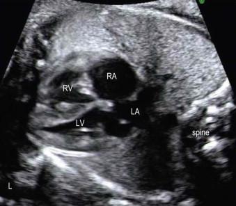 FIGURE 14-12, The fetal heart is seen in a lateral four-chamber view. The ventricles should appear equal in size. However, in the third trimester, the normal fetal heart may become slightly asymmetric as the right ventricle dominates over the left.