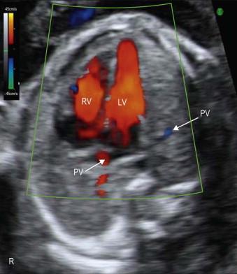 FIGURE 14-13, The fetal heart is seen in an apical four-chamber view. Colour Doppler demonstrates equal flow from the atria to the ventricles during ventricular diastole. PV: pulmonary veins.