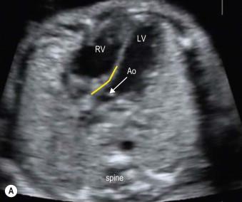 FIGURE 14-14, (A) The aorta is seen arising from the left ventricle in a transverse section just above (cranial to) the four-chamber view. The ventricular septum is continuous with the anterior wall of the aorta (yellow line). (B) Colour Doppler confirms forward flow in the left outflow tract and across the aortic valve.